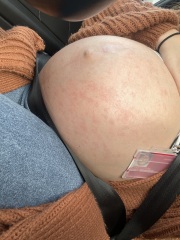 PUPPP pregnancy rash
