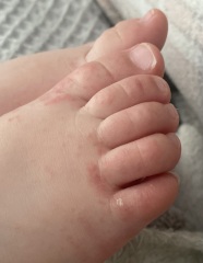Toddler painful / peeling toes??