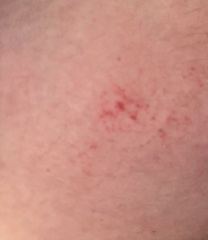 To ask what this rash is?