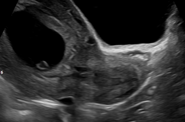Concerned! Weird shaped gestational sac at first ultrasound