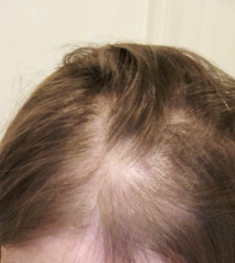 Hair thinning - panicking