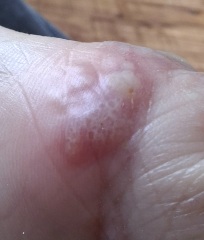 Hand infected (Warning, gross photos)