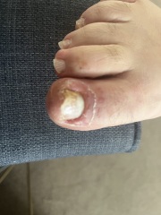 Manky toe