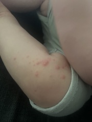 Is this chicken pox?