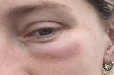 Woken up today with swelling under one eye? (Pics)