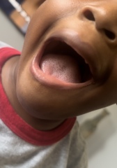 Could this be strawberry tongue from scarlet fever?