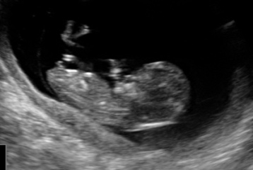 Nub Theory 12 week scan - can anyone help?