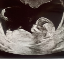 Did anyone have a boy nub on their 12 week scan but end up having a girl?