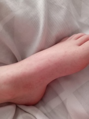 Hand foot and mouth?