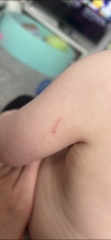 Petechiae on toddler? Photos attached