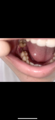 Tooth Extraction Healing