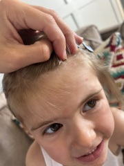 Advice Needed - Chickenpox or not?