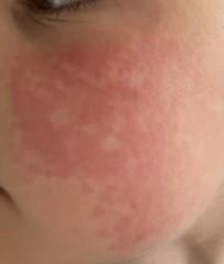 Slapped cheek or scarlet fever?