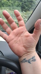 Methotrexate - Psoriasis