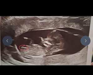 Locating the nub?