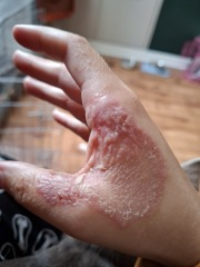 Hand infected (Warning, gross photos)