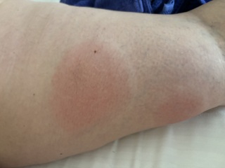 Skeeter Syndrome?