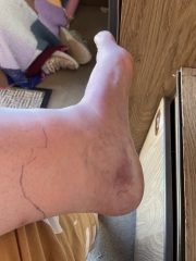 Sorry, having a panic - possible cellulitis?