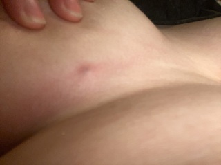 Lump under boob (picture)