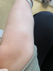 Little bruise and random single petechia that comes and goes