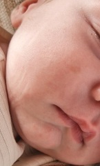 Is this a birthmark?