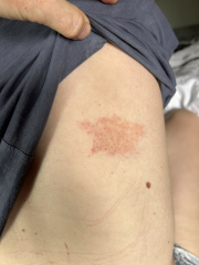 Infected bite?