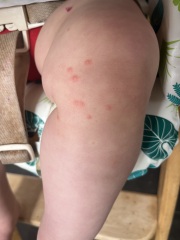 Is this chicken pox?