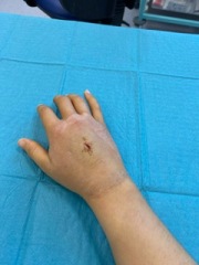 Hand infected (Warning, gross photos)