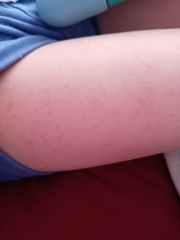 Hand foot and mouth?