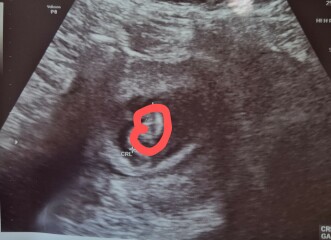 8 week scan