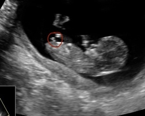 Nub Theory 12 week scan - can anyone help?