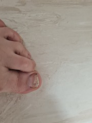 Is this fungal nail infection or something else