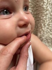 Unusual red rash on inner baby lip