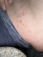 To ask what this rash is?