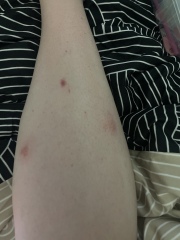 What on earth are these bites!