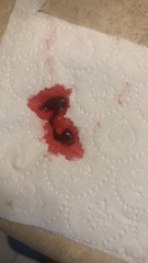 Blood clot or miscarriage? **MNHQ graphic pic warning**