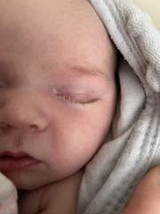 Conjunctivitis?