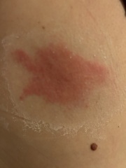 Infected bite?