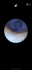 Any Drs or ear specialists on? Pic of eardrum