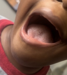 Could this be strawberry tongue from scarlet fever?