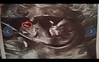 Locating the nub?