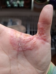 Hand-wash when having an extremely eczema breakout?