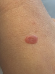 6 year old, red spot in hand