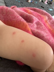 Bites - double bites in same spots???