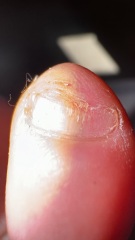 Is this fungus returning? Warning photos