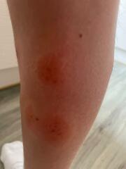 Please help keep identify these bites