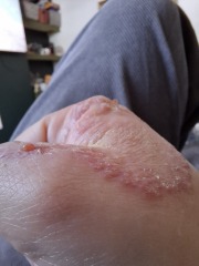 Hand infected (Warning, gross photos)