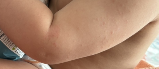 If your child had reaction to first MMR vax did they also react to the 2nd dose?