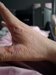 Hand infected (Warning, gross photos)