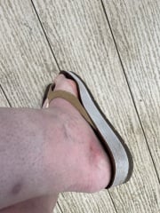 Sorry, having a panic - possible cellulitis?